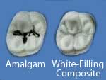 White Composite Fillings