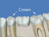 Porcelain Crowns and Bridges