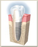 Dental Implant