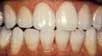 After Tooth Whitening